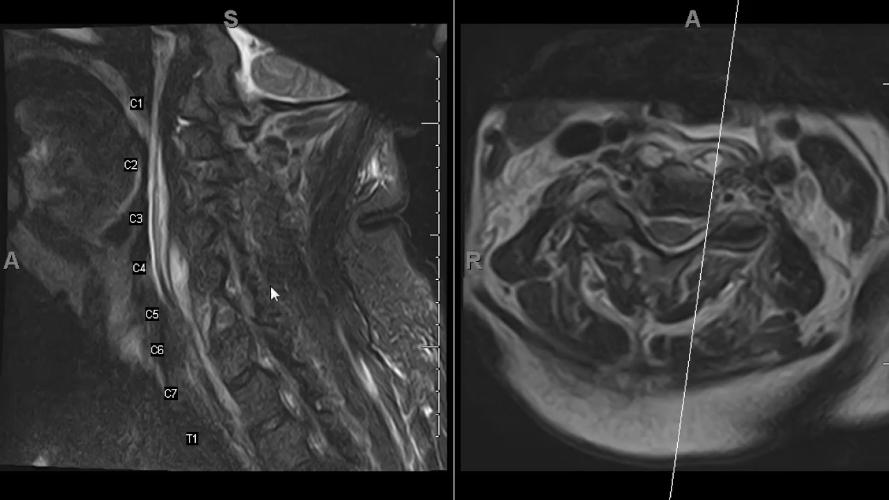 Spinal epidural abscess is easy to miss. T1 images are key.