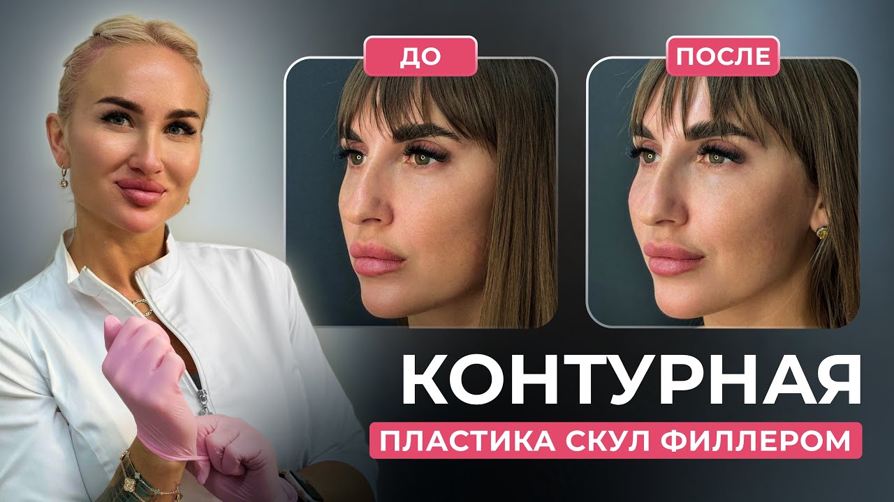 Контурная пластика скул филлером