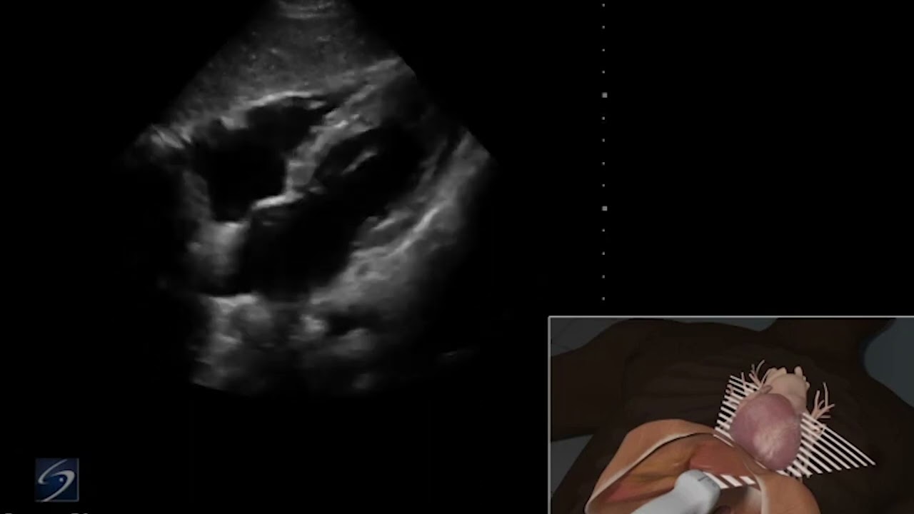 EFAST Ultrasound