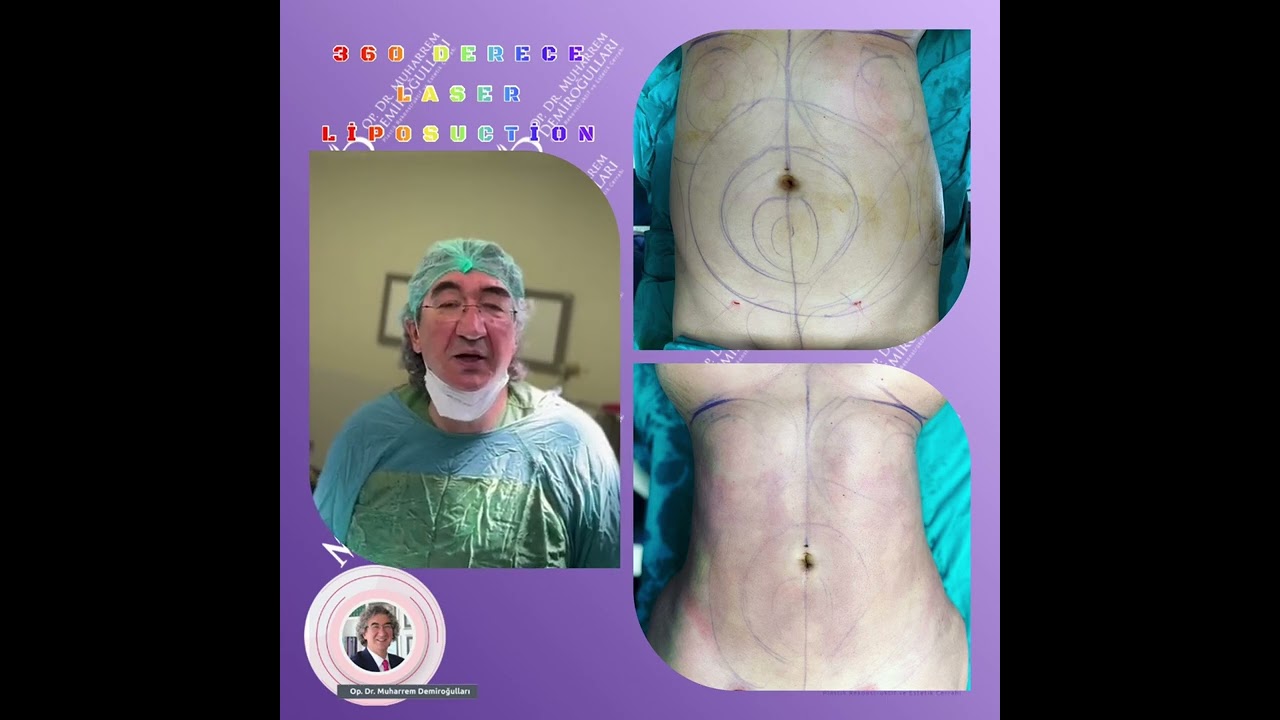 360 DERECE LASER LİPOSUCTİON İLE VÜCUT ŞEKİLLENDİRME