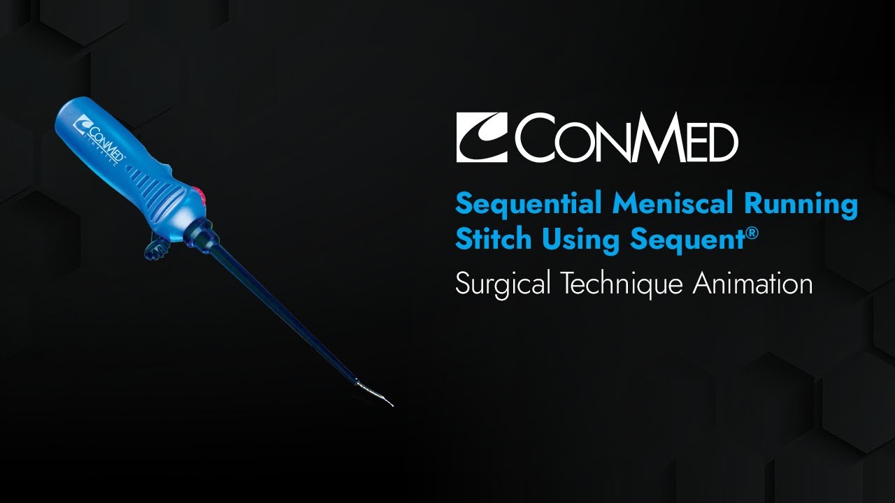 Последовательный менискальный бегущий шов с использованием Sequent&reg; - анимация CONMED