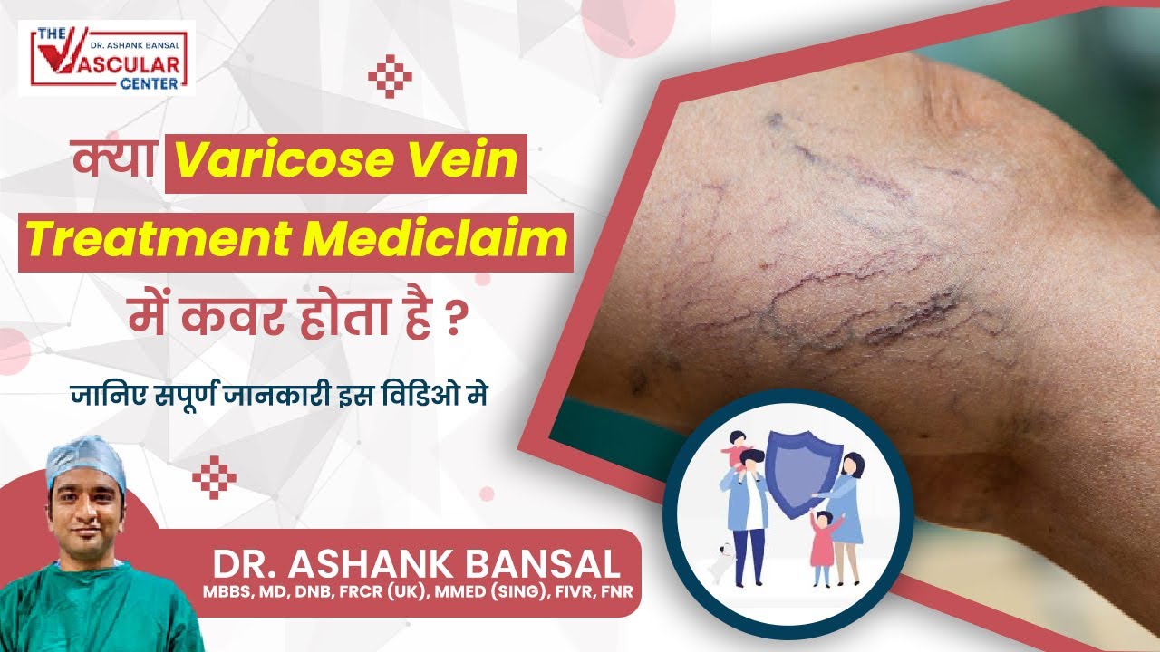 Guide to Cashless Medical Insurance for Varicose Vein Surgery | By Dr. Ashank Bansal