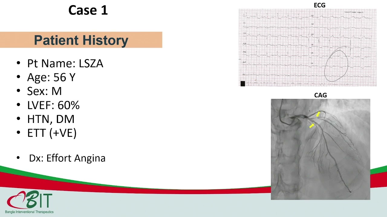 IVUS for Complex PCI: Secret Pearls from Expert by Dr Afzalur Rahman
