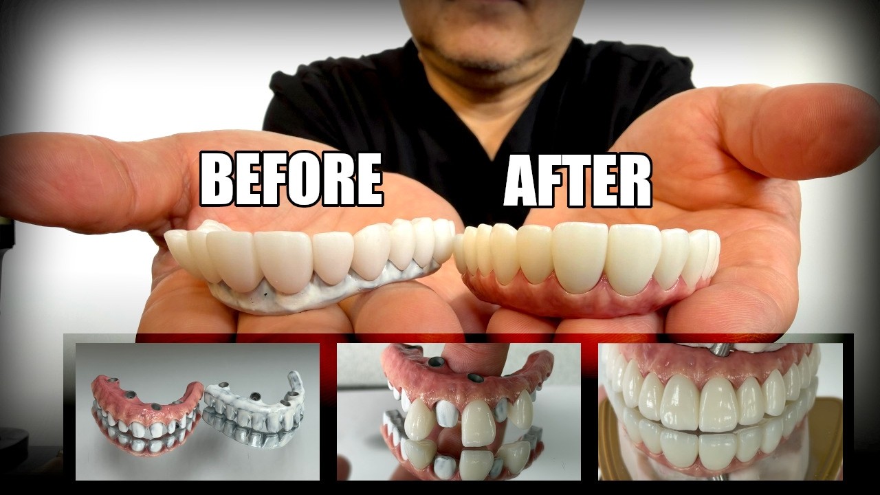 Full-Arch Zirconia, 4-Implant Restoration with Long-Span that Will Not Crack