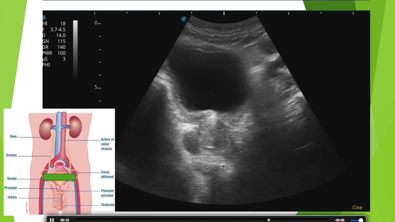 Cancer de prostate en échographie