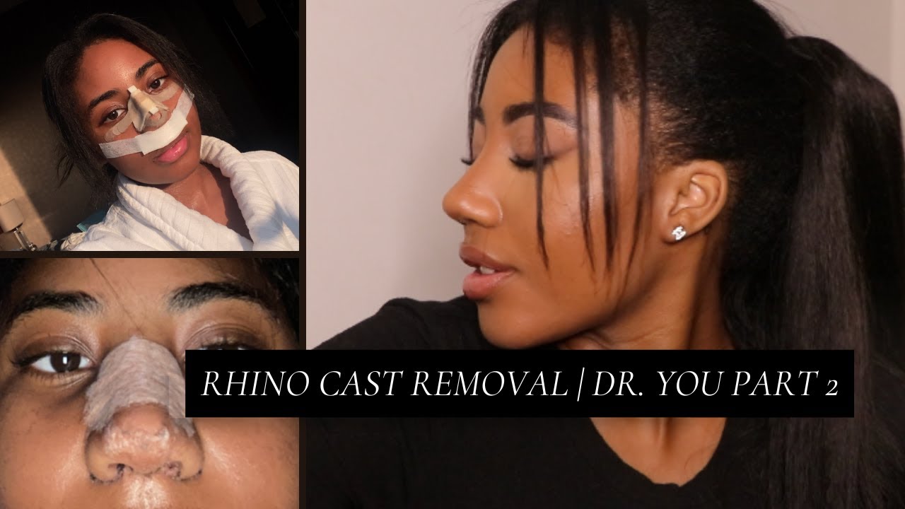 CAST REMOVAL | NOSE JOB VLOG PART 2