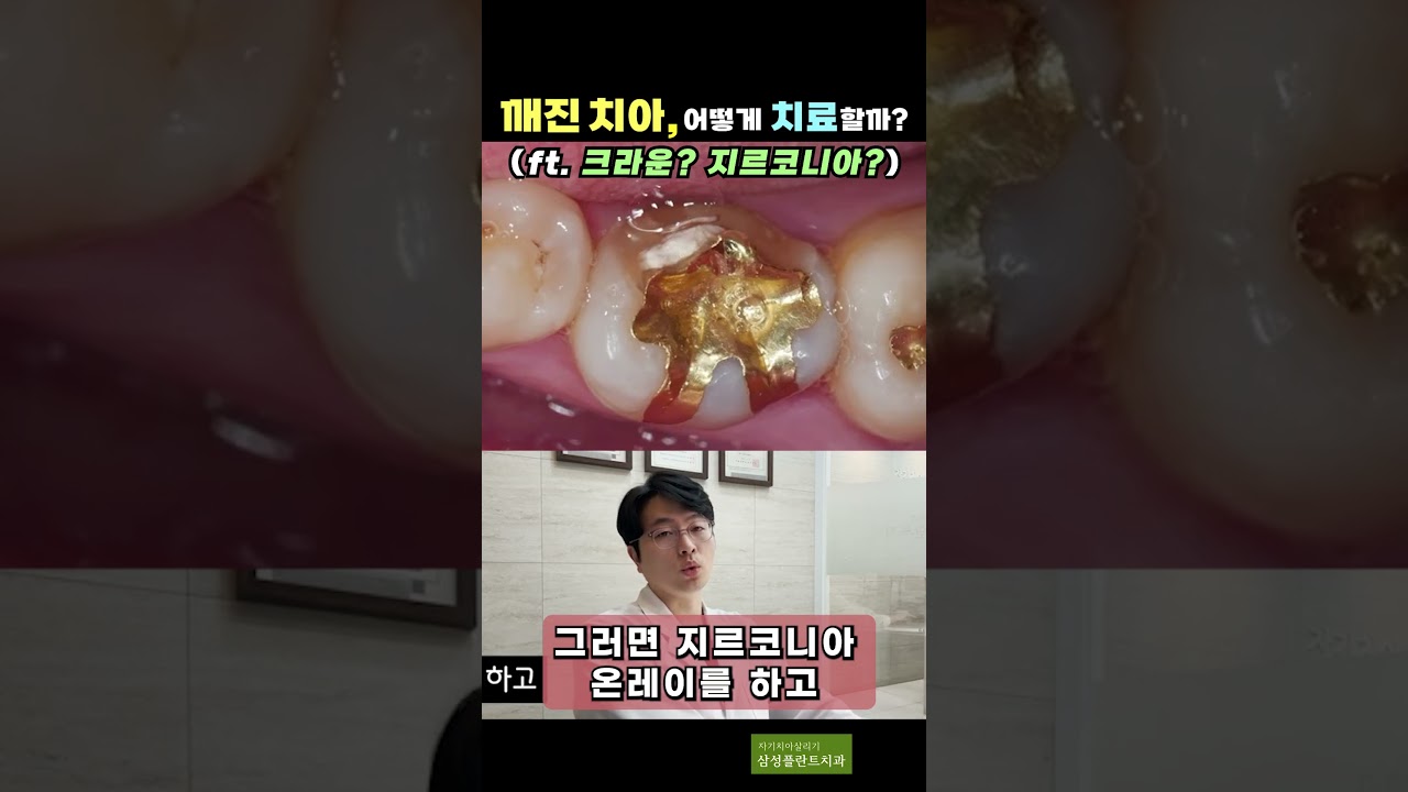 크라운 vs 온레이 치아 삭제량은?#자기치아살리기