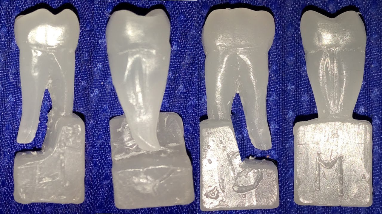 Carving of mandibular first molar
