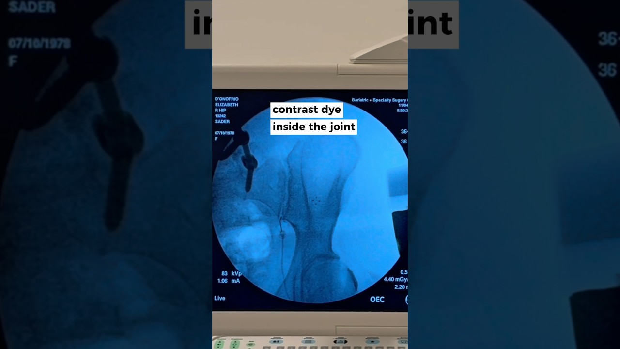 sacroiliac joint (SI joint) pain relief 