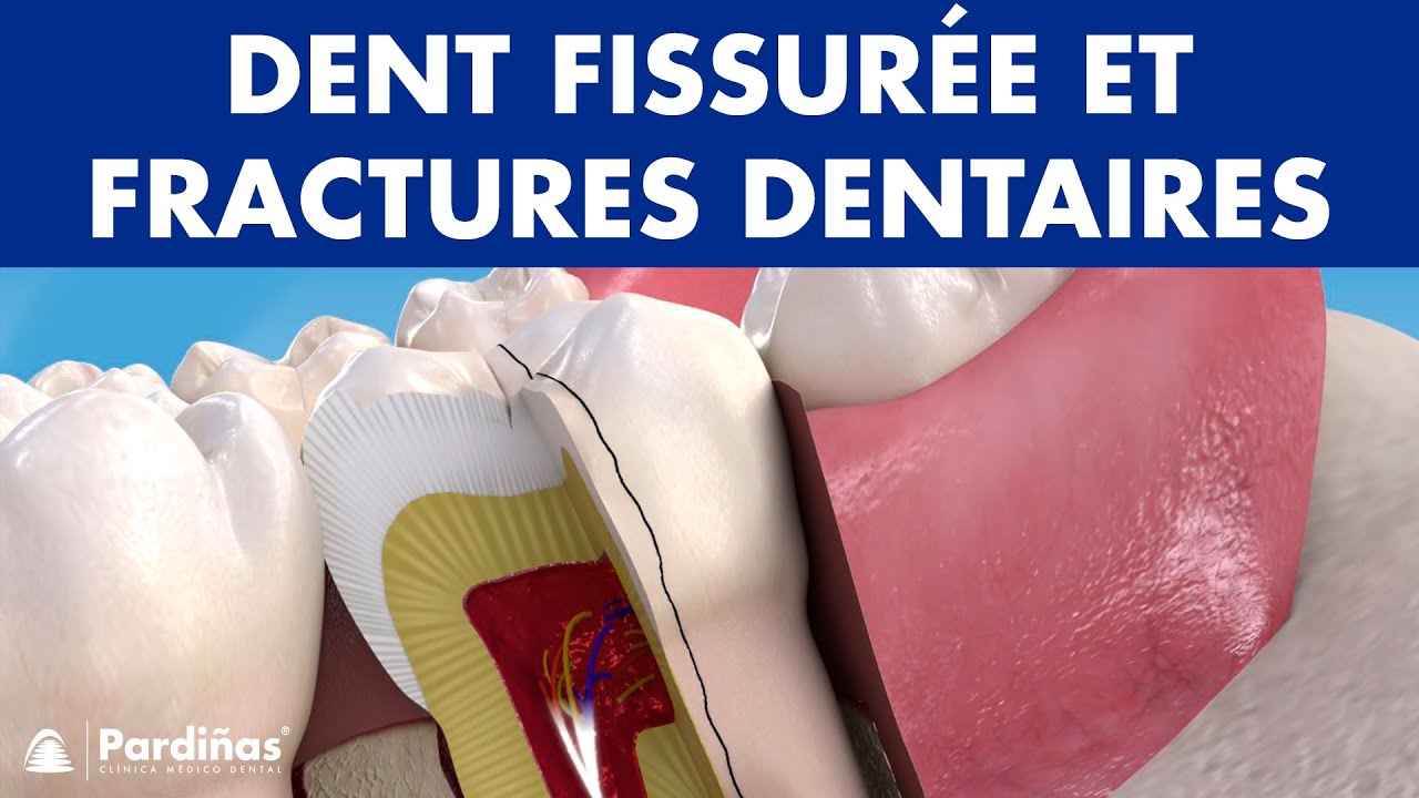 DENTS CASSÉES - Symptômes et types: dents fissurées et fractures dentaires ©