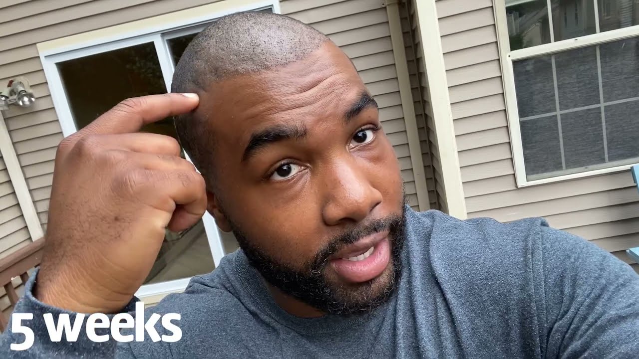 Asli Tarcan | African American | Hair Transplant | Weeks 4-6