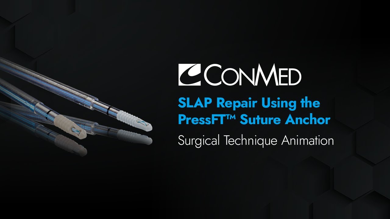 SLAP Repair Using the PressFT™ Suture Anchor - CONMED Animation