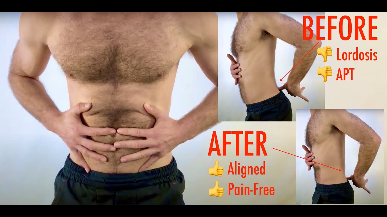 Pilates Imprint vs Neutral Spine | Core Stability Explained | Reduce Back Pain from Lordosis or APT