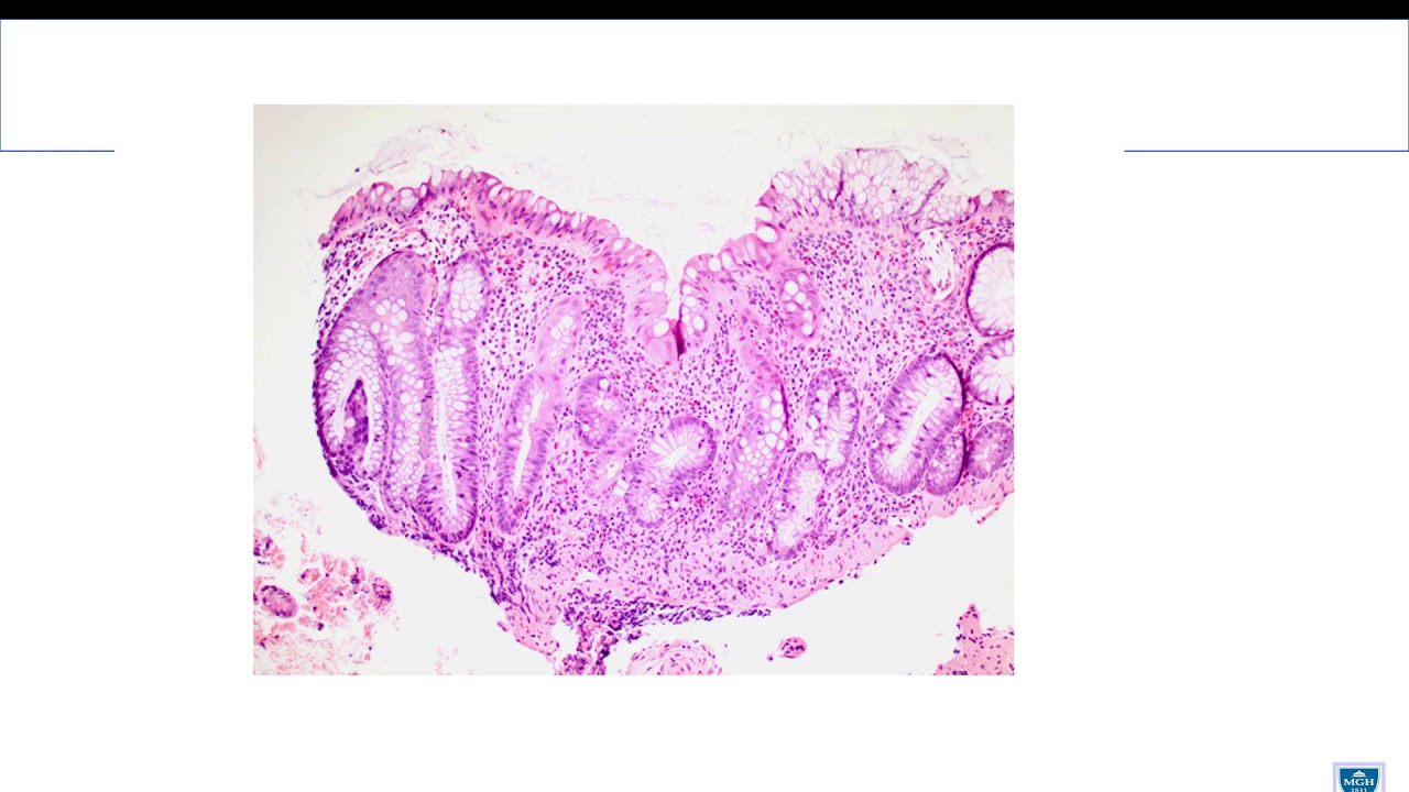The differential diagnosis of chronic colitis