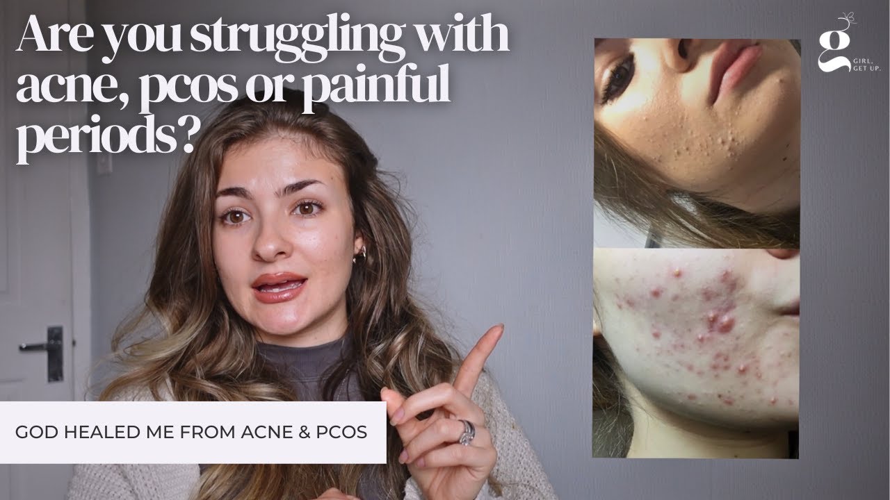 How God healed my ACNE, PCOS & PAINFUL PERIODS after struggling for 5 years!