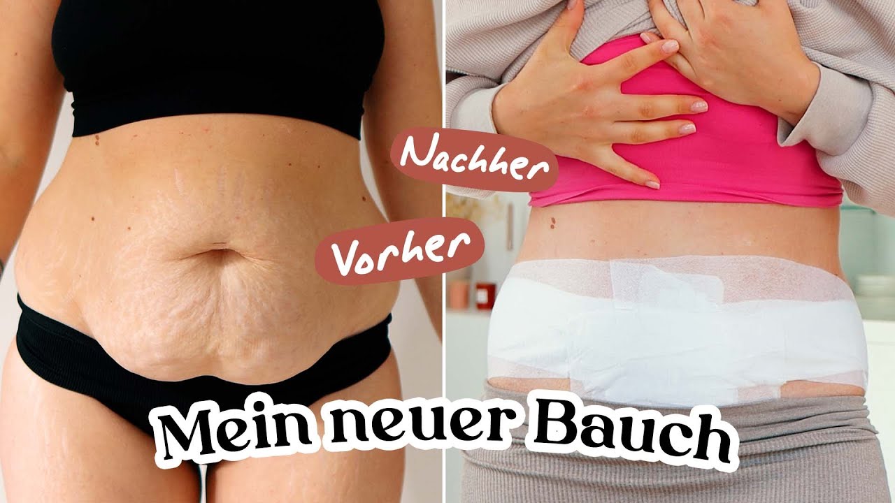 Heilungsprozess und Ergebnis meiner Bauchdeckenstraffung | 4 Wochen Tagebuch | TEIL 2
