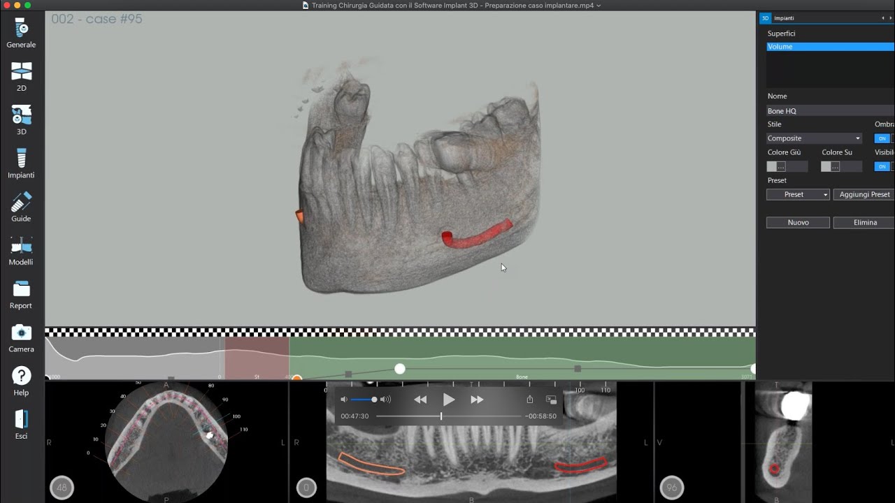 1°Lezione Webinar Implant 3D: Preparazione caso implantare