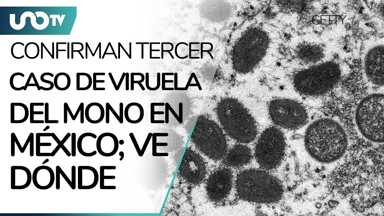 Segundo caso de Viruela del Mono en CDMX y tercero en M&eacute;xico