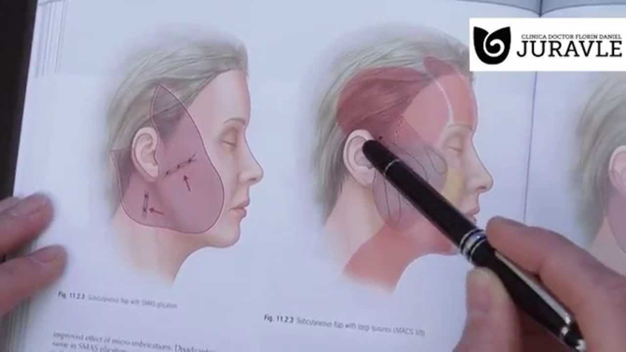 Liftingul facial