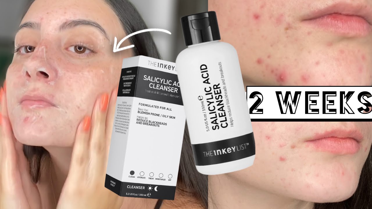 TESTING THE INKEY LIST SALICYLIC ACID CLEANSER ON MY ACNE DRY SKIN FOR 2 WEEKS