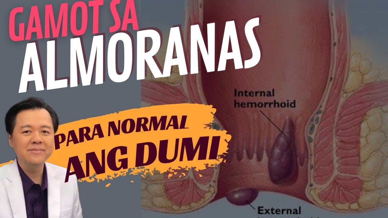 Gamot sa Almoranas at Para Maging Normal ang Pagdumi - Tips ni Doc Willie Ong
