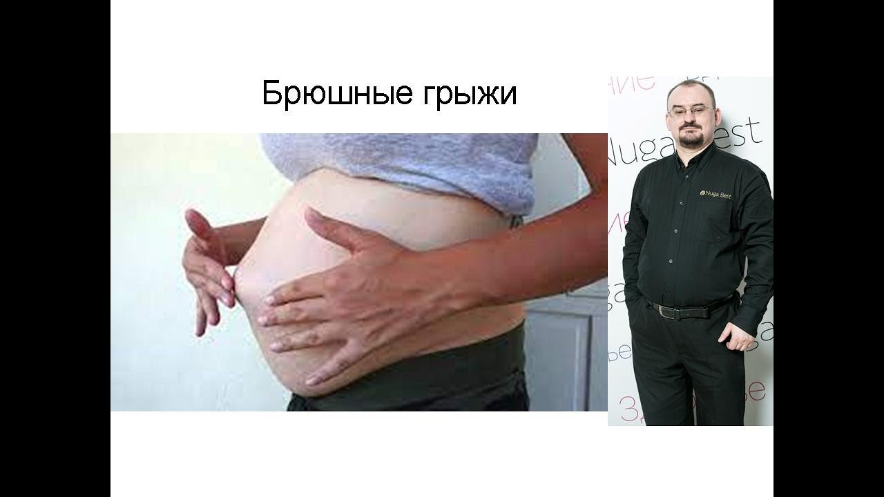 Брюшные грыжи