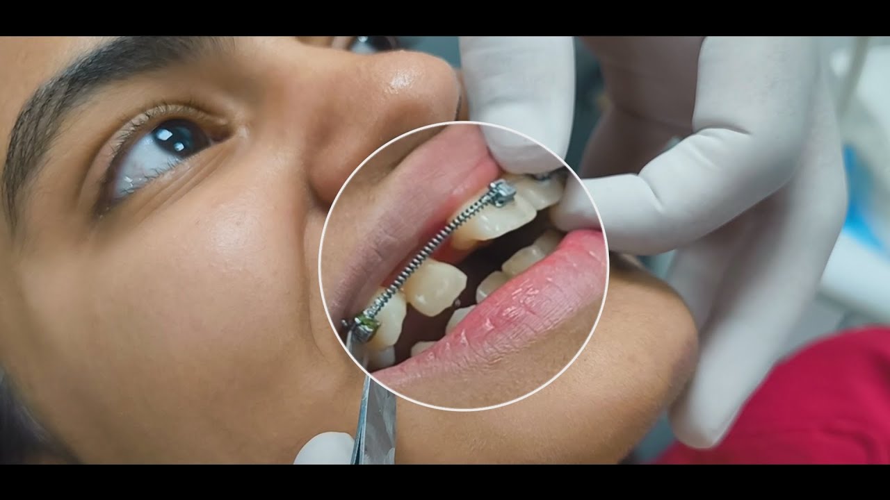 Correcting a Blocked-Out Lateral Incisor: Treatment Options and Solutions #orthodontics