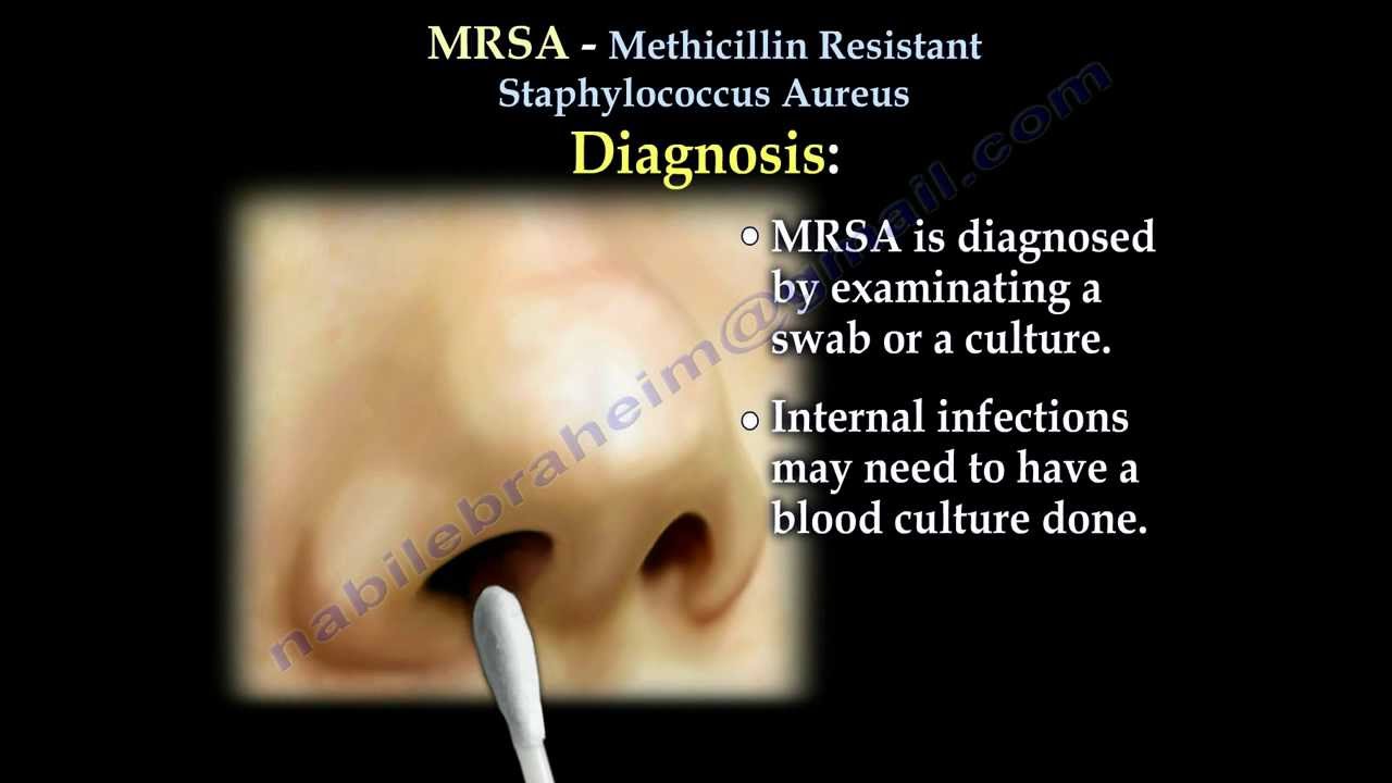 MRSA Methicillin Resistant Saphylococcus Aureus - Everything You Need To Know - Dr. Nabil Ebraheim