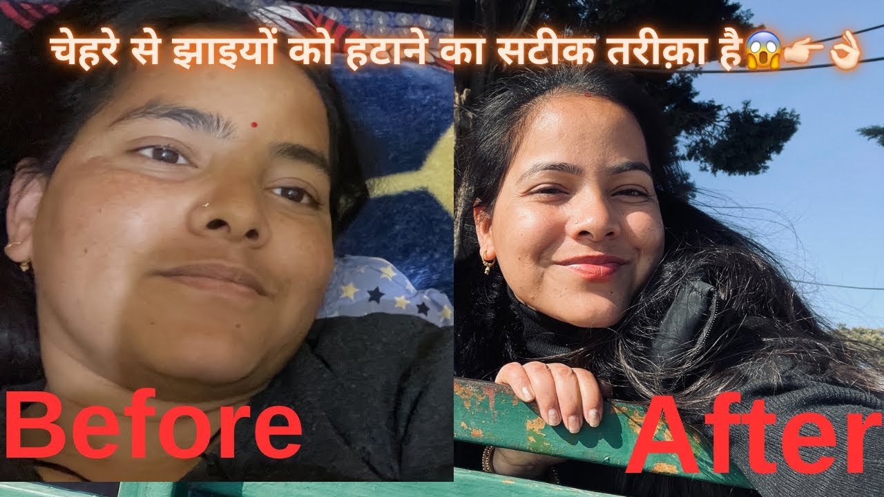 चेहरे की पुरानी सी पुरानी झाइयाँ कैसे करें ठीक ✅ ॥ 
