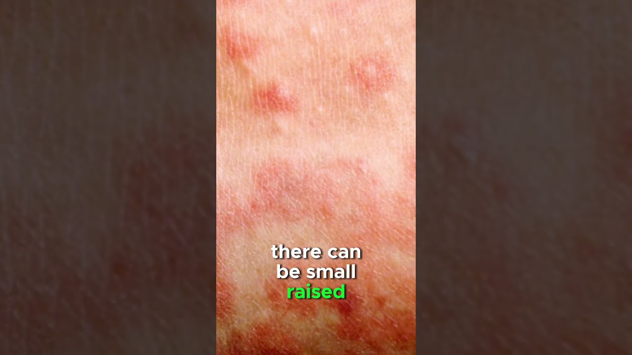 Measles rash explained | #health #measles #doctor #MMR #vaccine #publichealth
