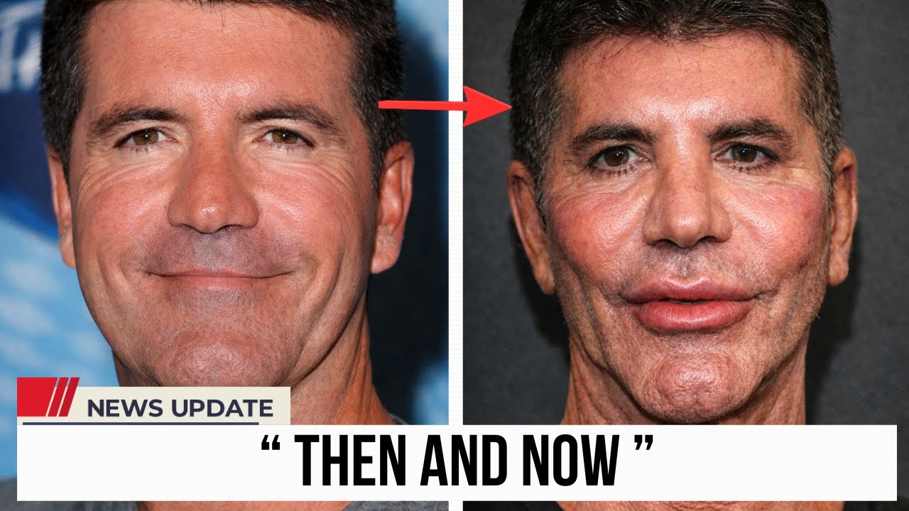 10 Celebrities Before and After Plastic Surgery | Then and Now 2026
