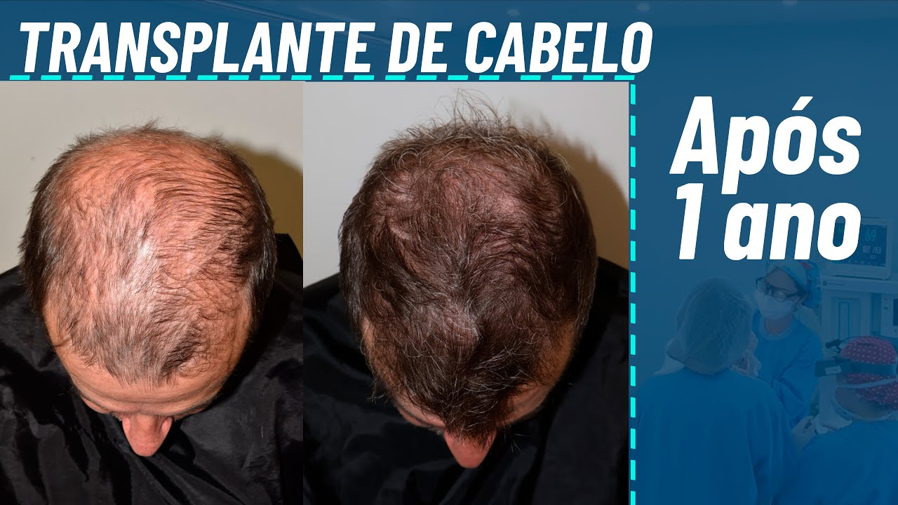 Transplante de cabelo após um ano #antesedepoisimplantecapilar #transplantecapilar #implantecapilar