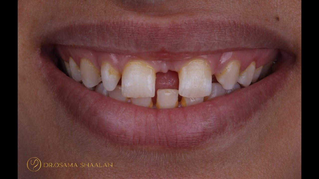 Combined approach for large diastema closure part II