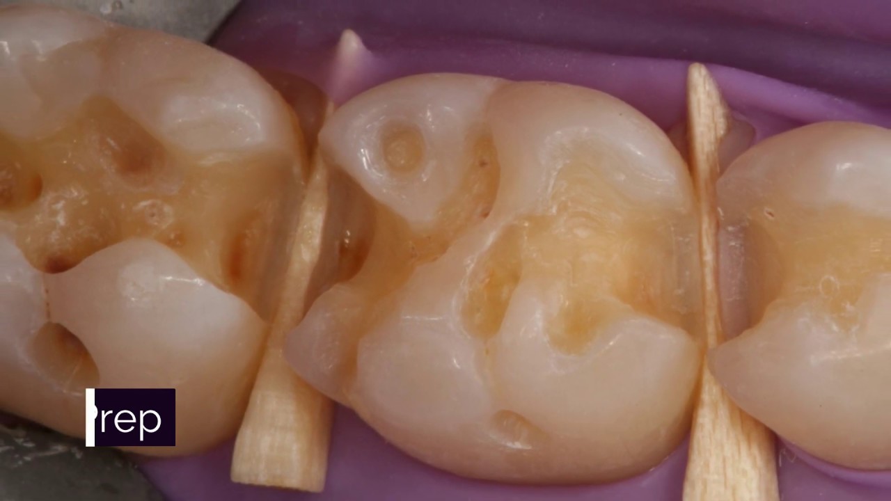 Posterior Composites - The Selective Etch Technique | DOTHANDSON