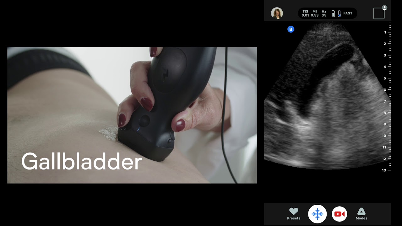 Butterfly iQ: One Probe, Whole Body Imaging