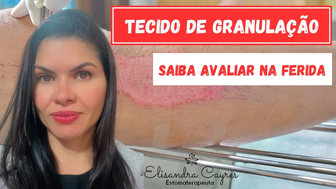 TECIDO DE GRANULAÇÃO - ESTOMATERAPIA