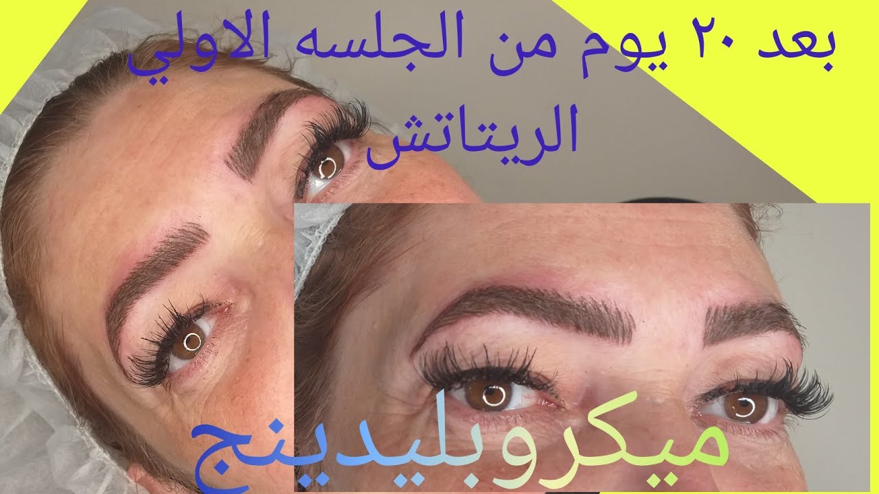 بعد مرور 20 يوم علي الميكروبليدنج (الريتاتش) مع الكلينت بالتفاصيل 👌