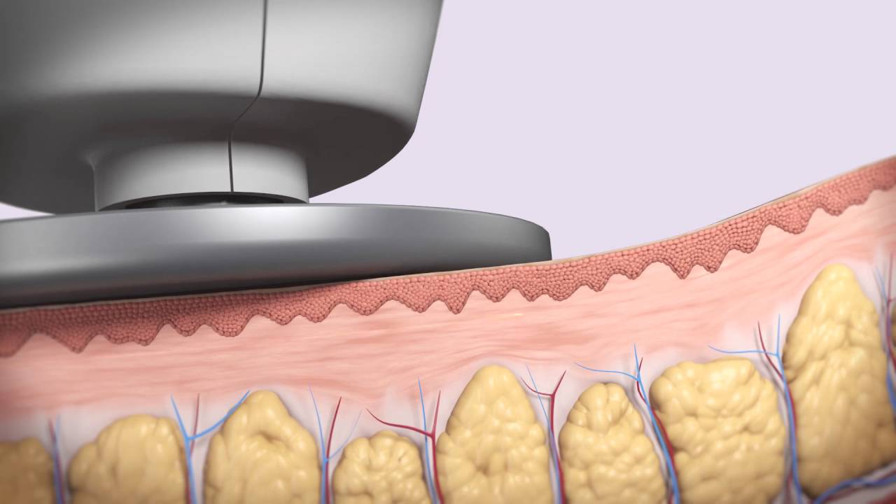ACCENT PRIME: LO ÚLTIMO EN REMODELACIÓN CORPORAL DE ALMA (eng)