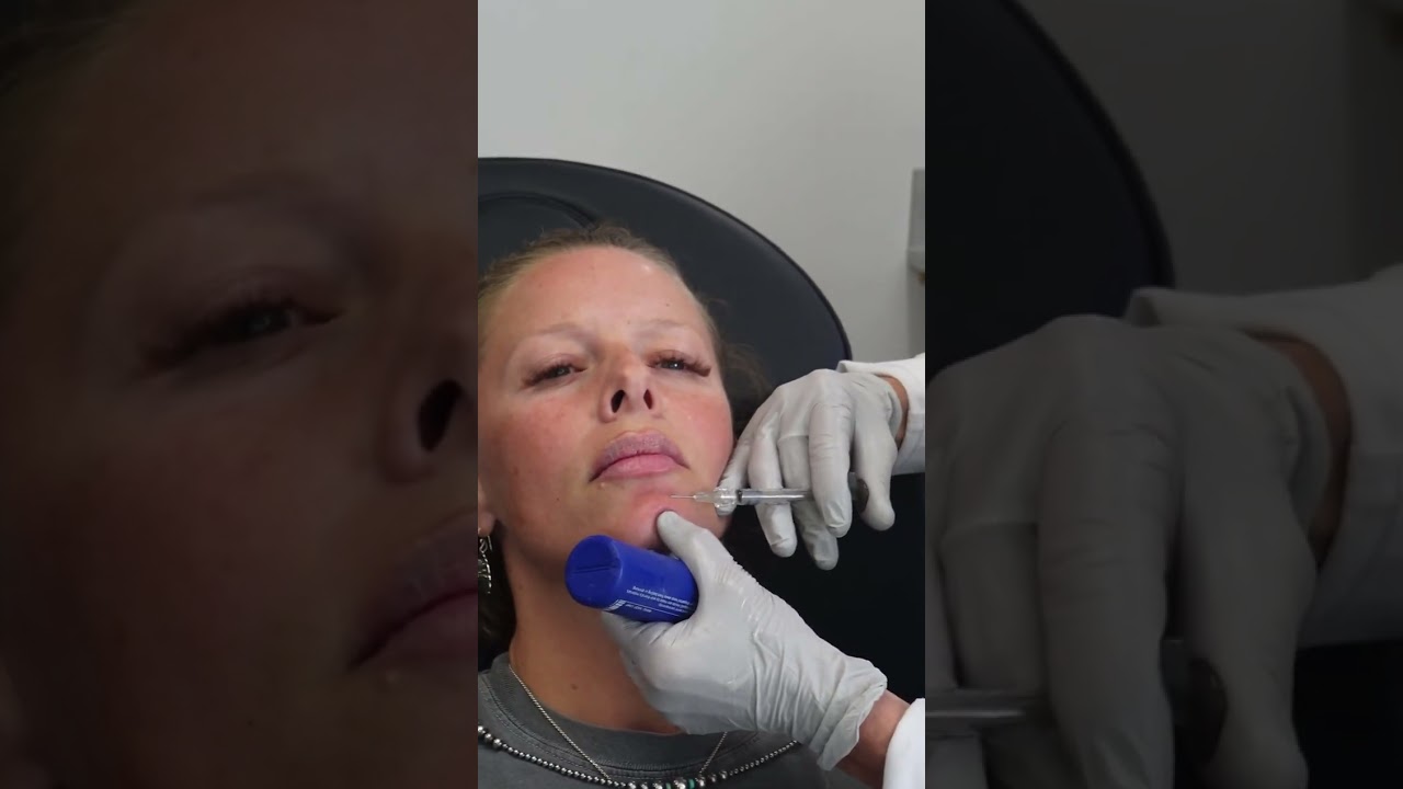 Fixing the Chin Crease: Mentalis Filler Technique Explained