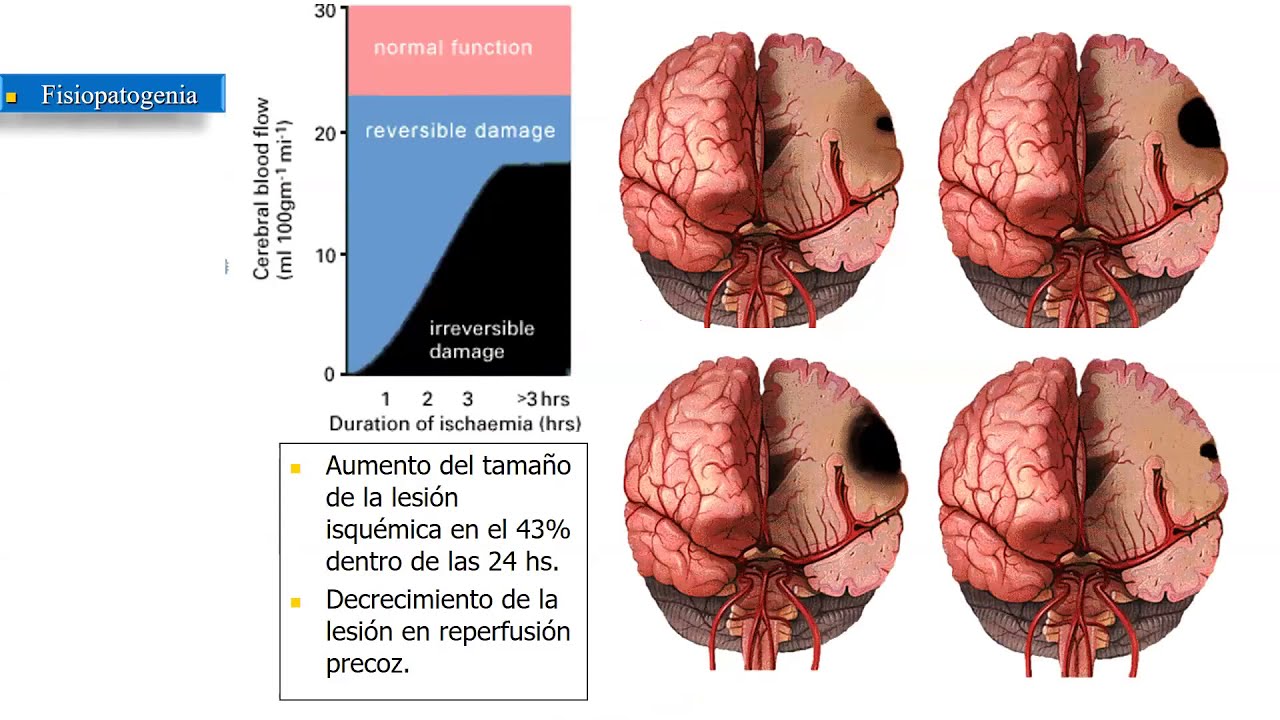 Isquemia cerebral