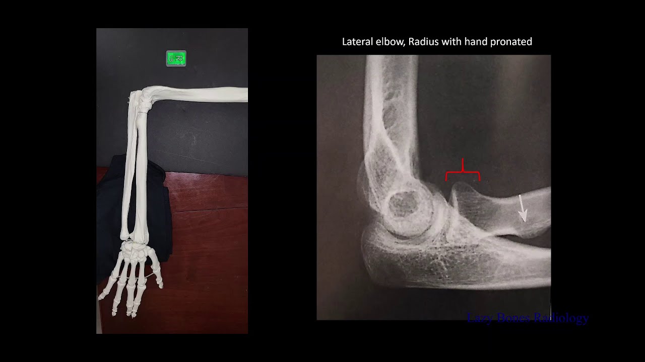 Позиционирование локтя. Эпизод 11. #LazyBonesRadiology