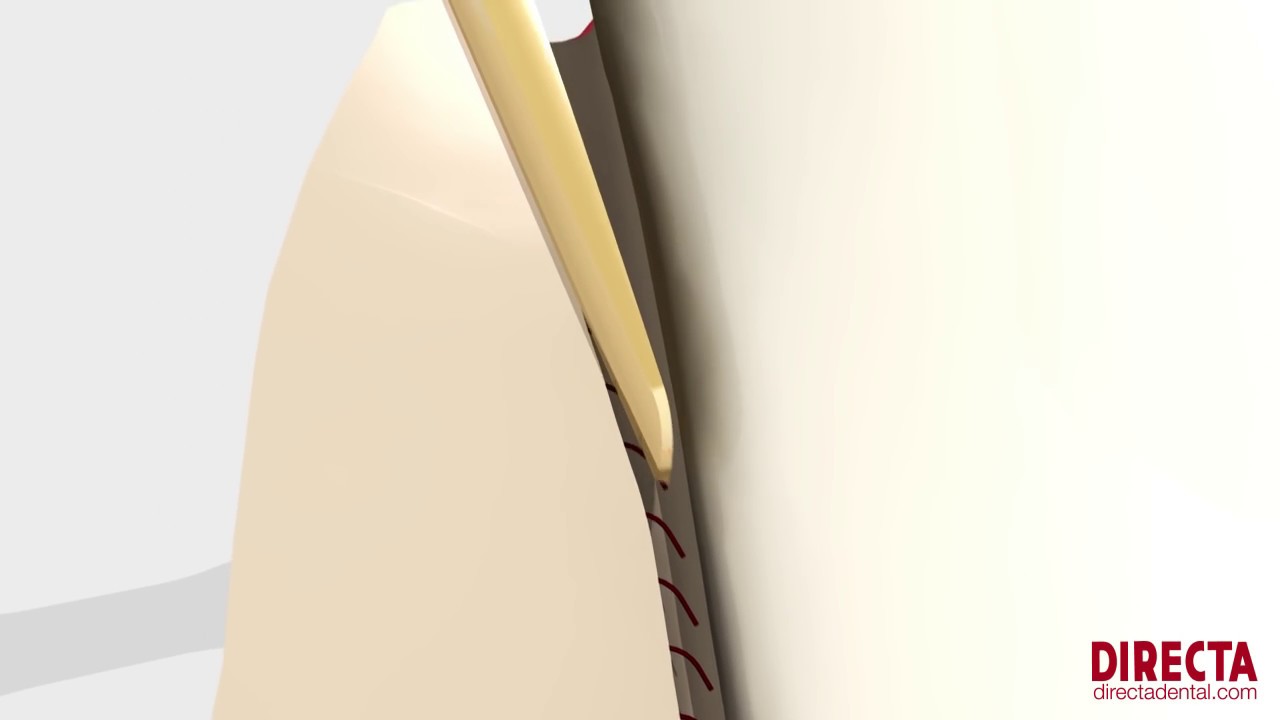 Luxator&reg; LX by Directa - Mechanical Periotome by Directa