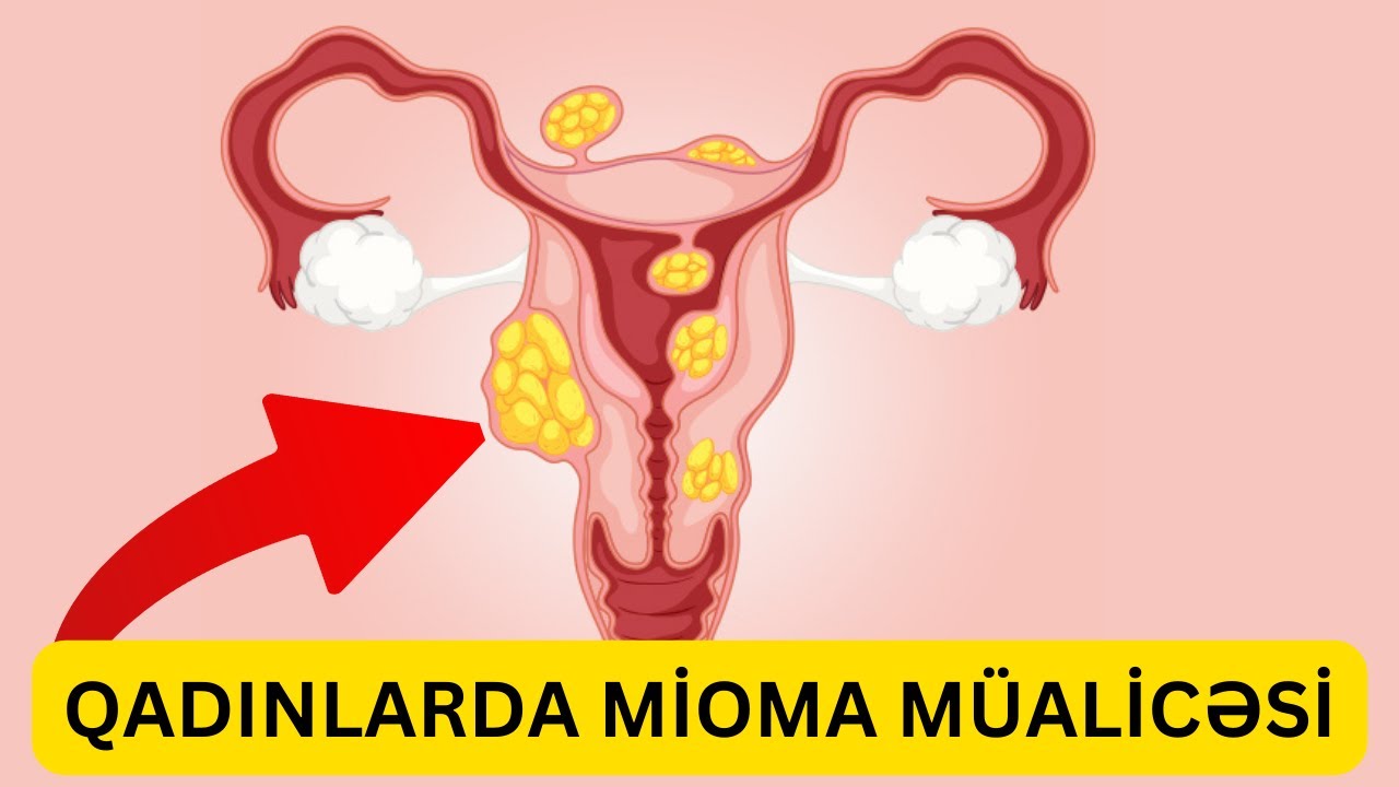 Mioma - Müalicə edilə bilər?