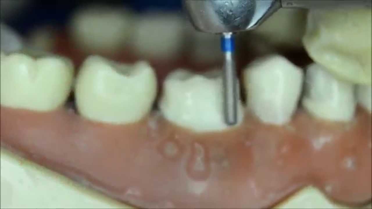 Tallado molar 46 parte 2