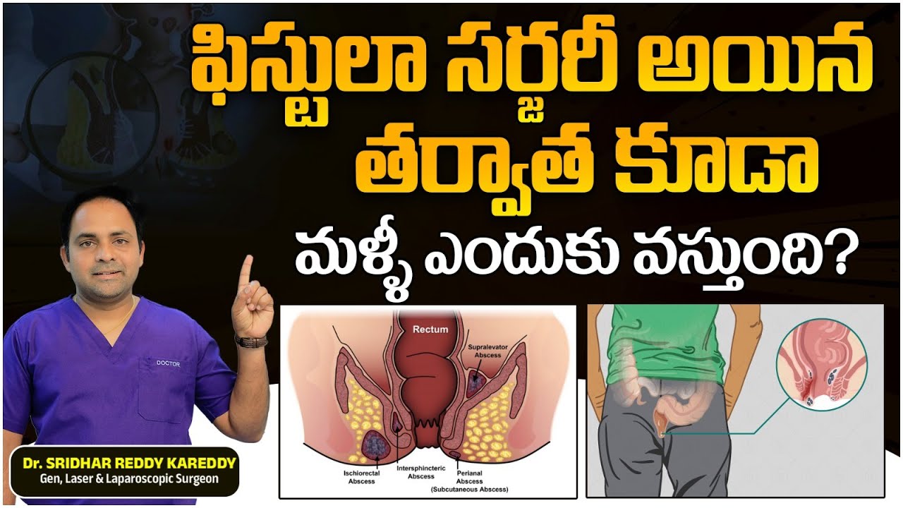 Fistula Symptoms and Treatment in Telugu | Fistula Treatment | Gut Health | Dr Sridhar Reddy