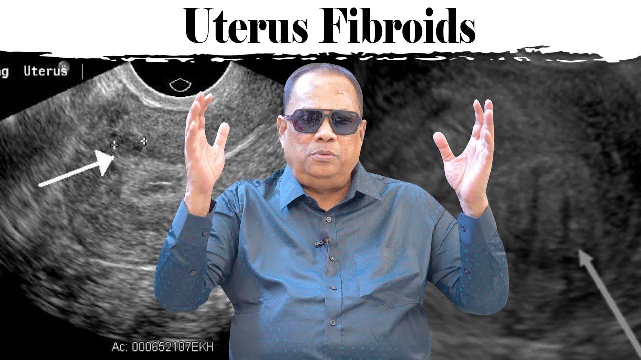 UTERUS FIBROIDS / CKN