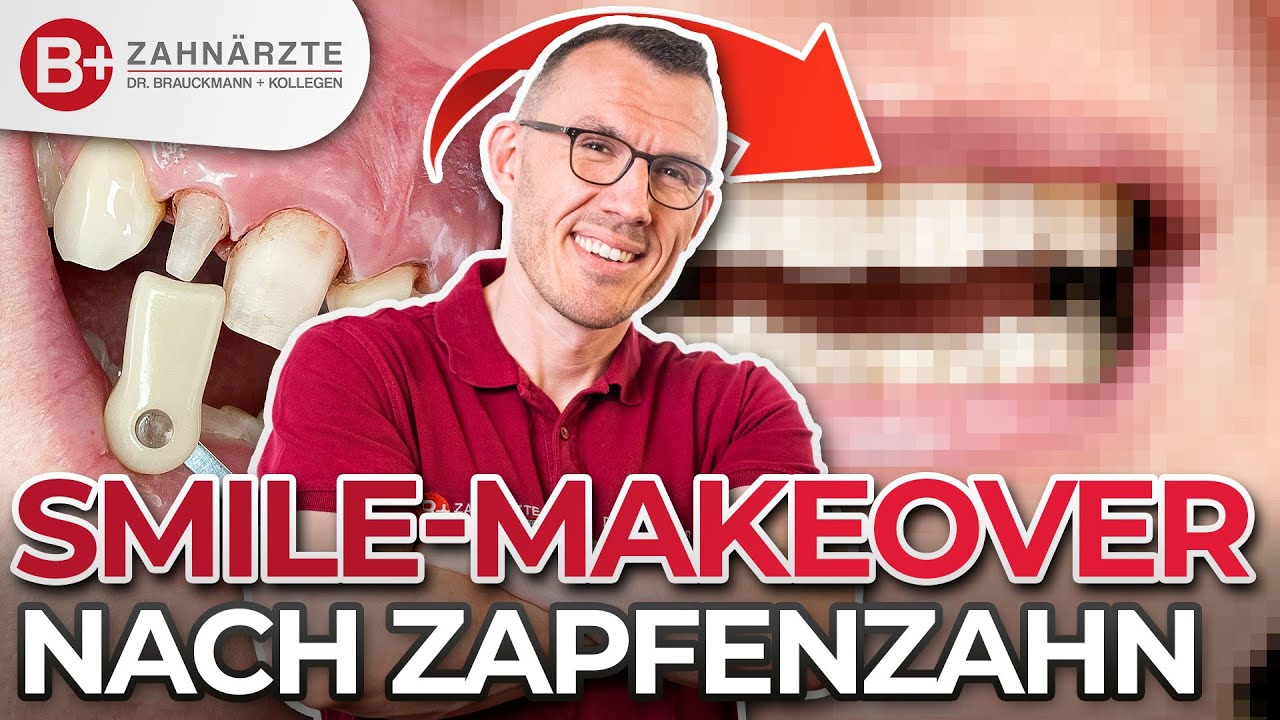 Zahnkronen und Veneers // Smile Makeover im Oberkiefer mit Zapfenzahn