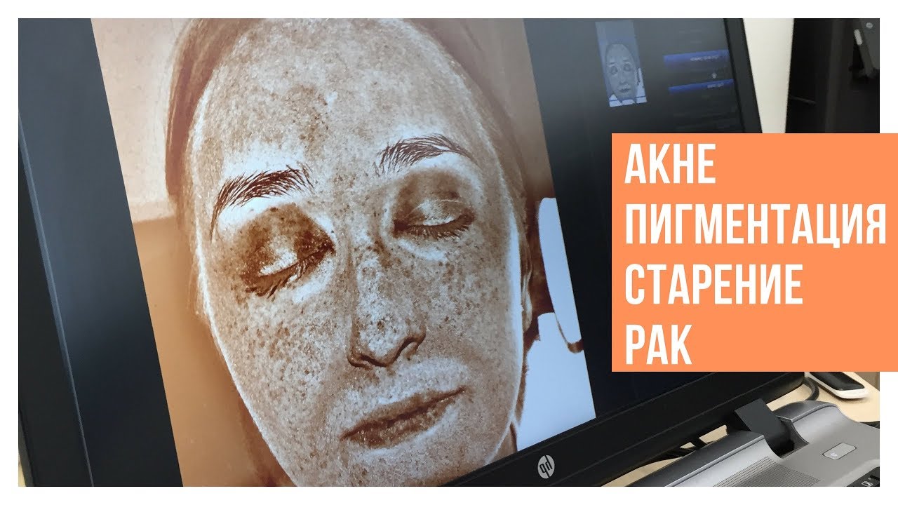 ЗАГАР - ЭТО ГЛУПО. ВЫБОР SPF ДЛЯ КОЖИ ЛИЦА