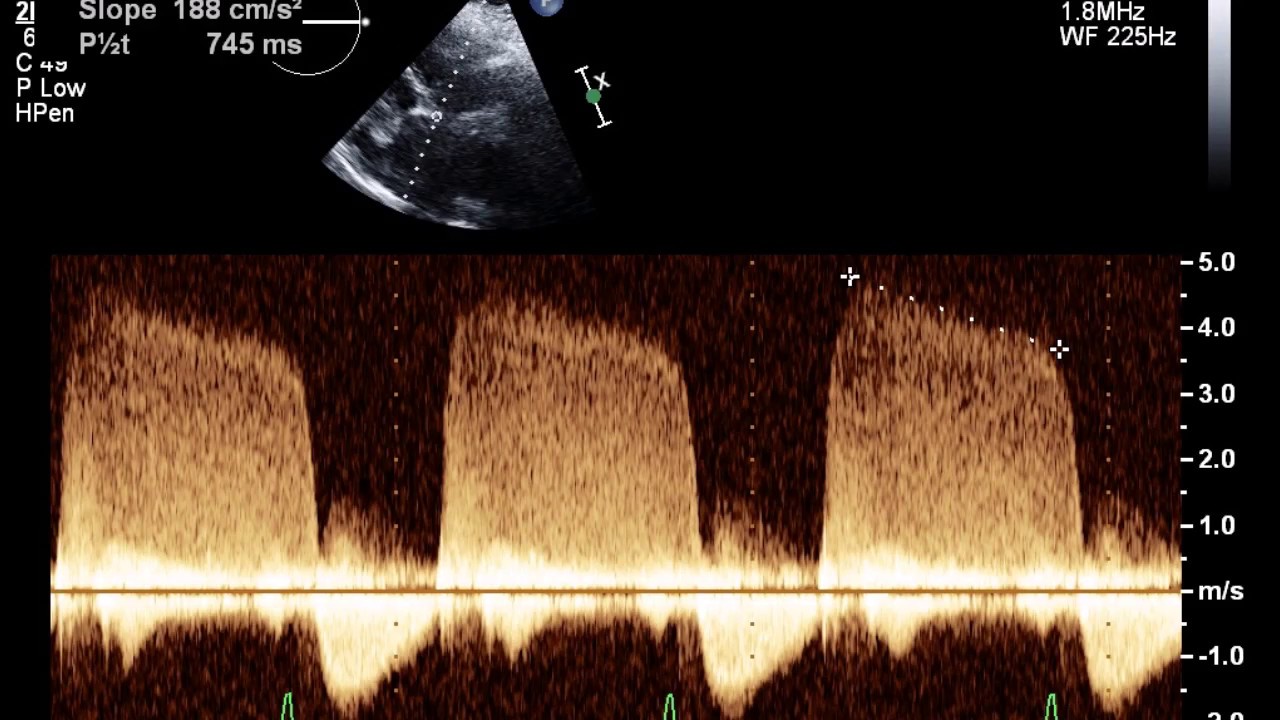 Echocardiogram With Mild Aortic Insufficiency