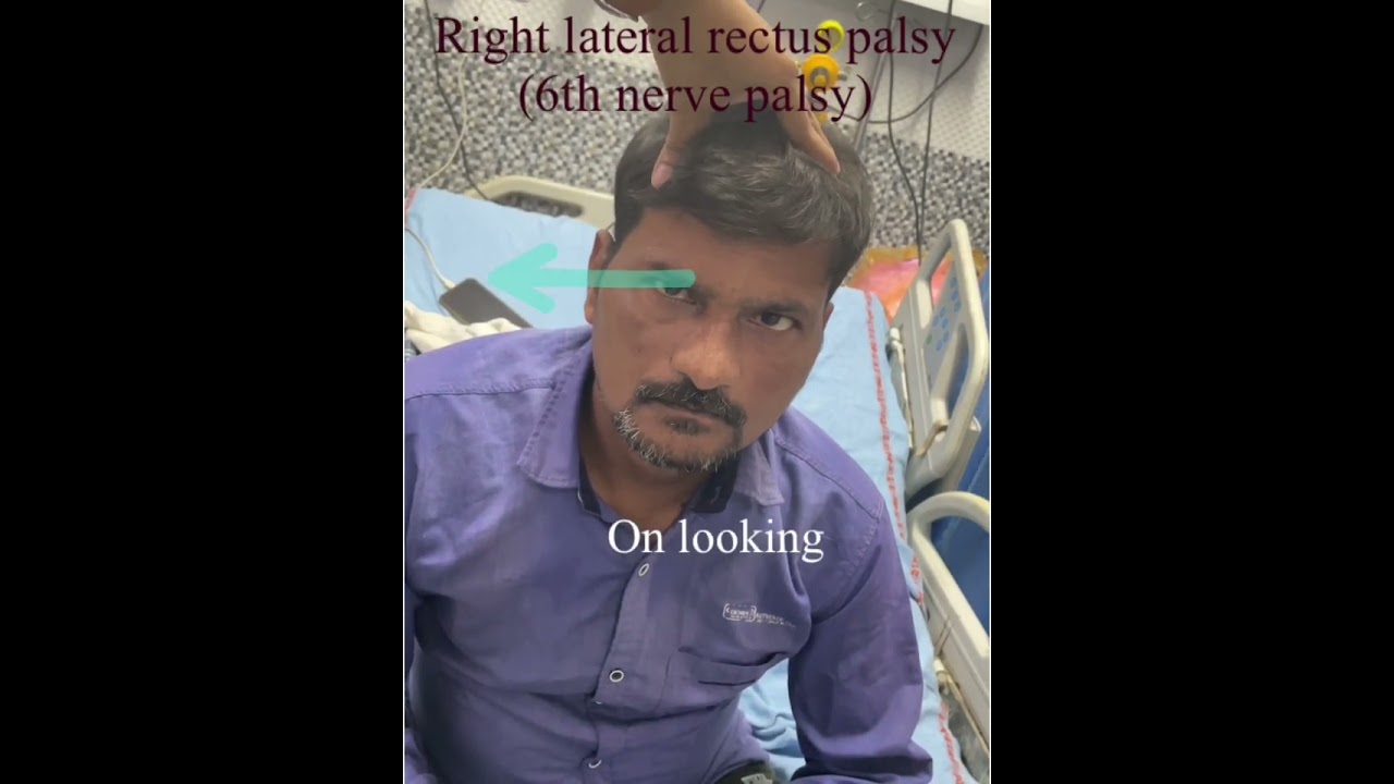 Right lateral rectus palsy